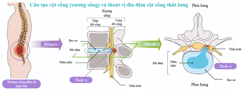 cau tao cot song va thoat vi dia dem cot song