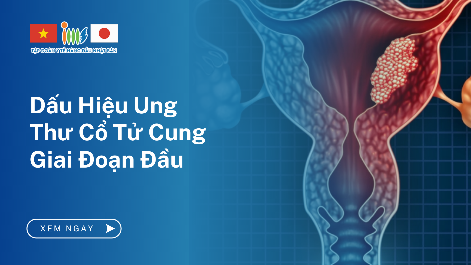 Dấu Hiệu Ung Thư Cổ Tử Cung Giai Đoạn Đầu