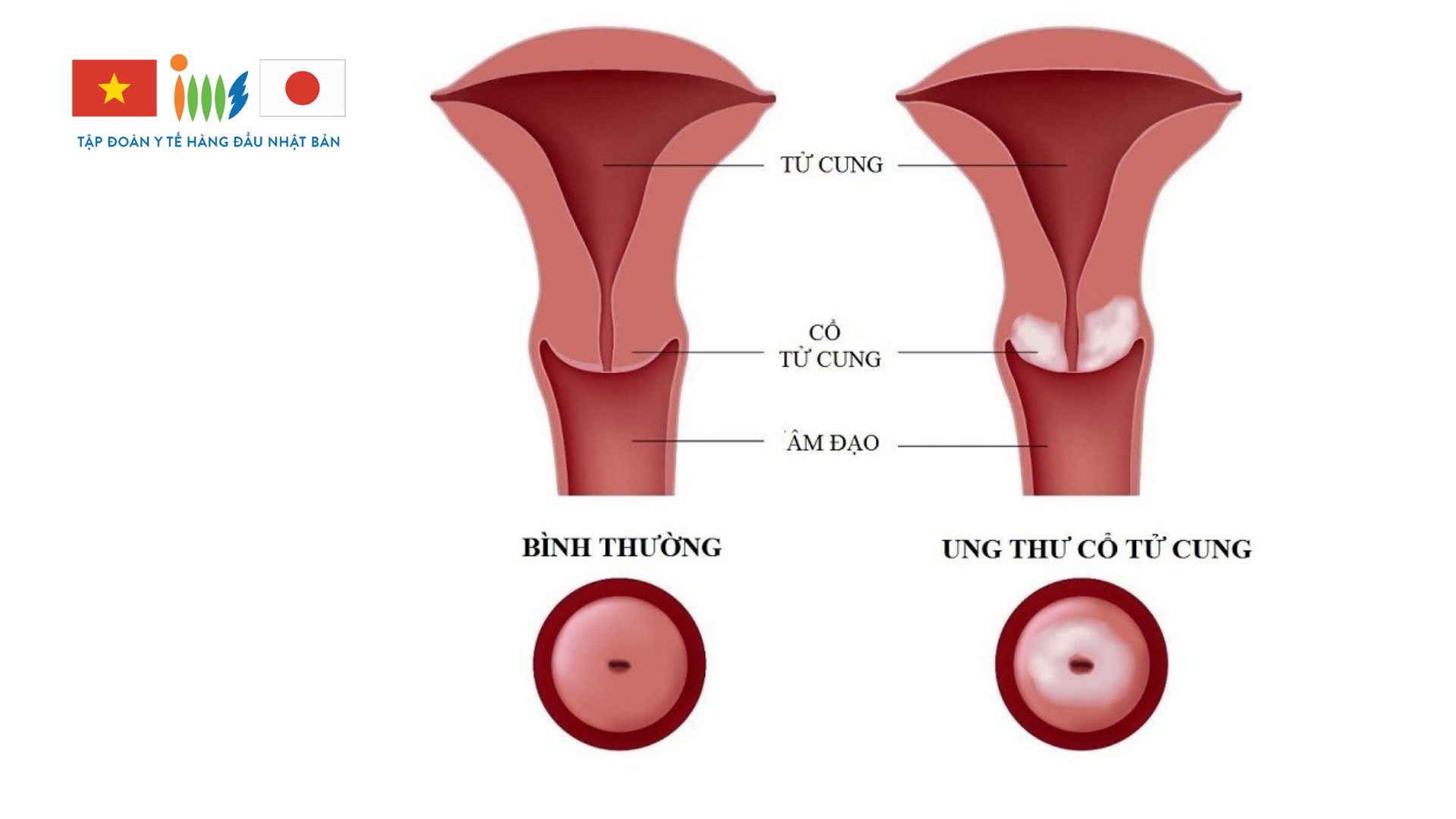 Ung thư cổ tử cung là một loại ung thư phổ biến ở phụ nữ