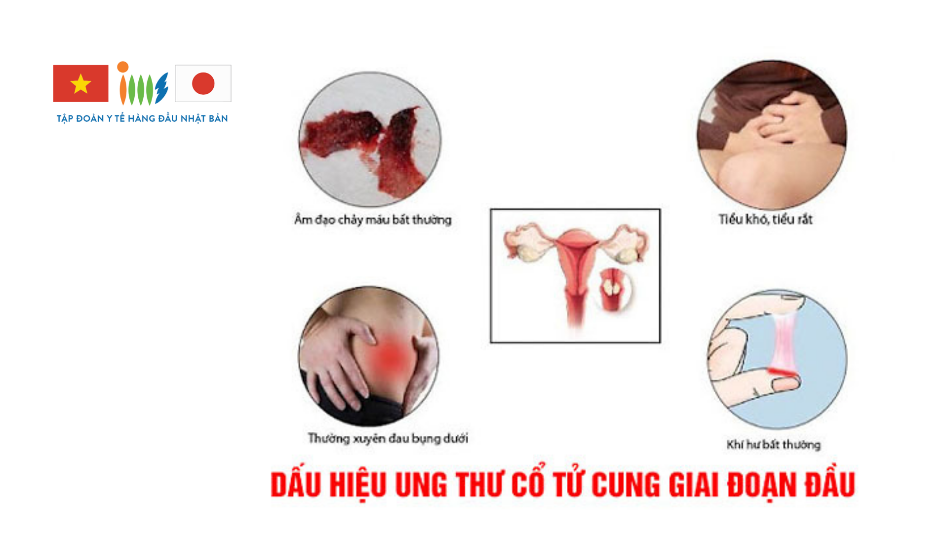 Dấu Hiệu Ung Thư Cổ Tử Cung Giai Đoạn Đầu