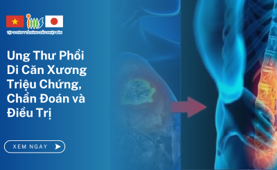 Ung Thư Phổi Di Căn Xương: Triệu Chứng, Chẩn Đoán và Điều Trị