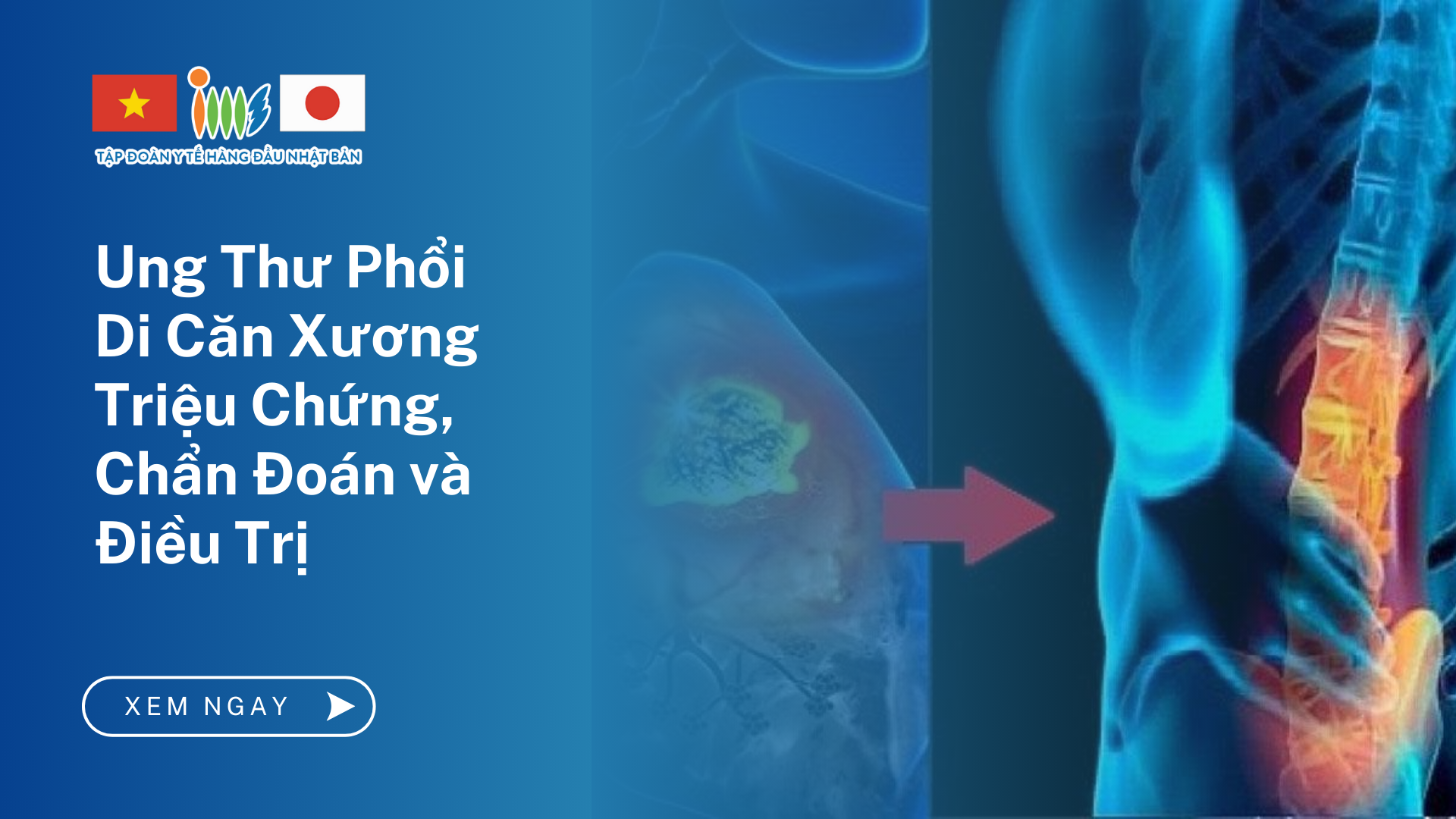 Ung Thư Phổi Di Căn Xương: Triệu Chứng, Chẩn Đoán và Điều Trị