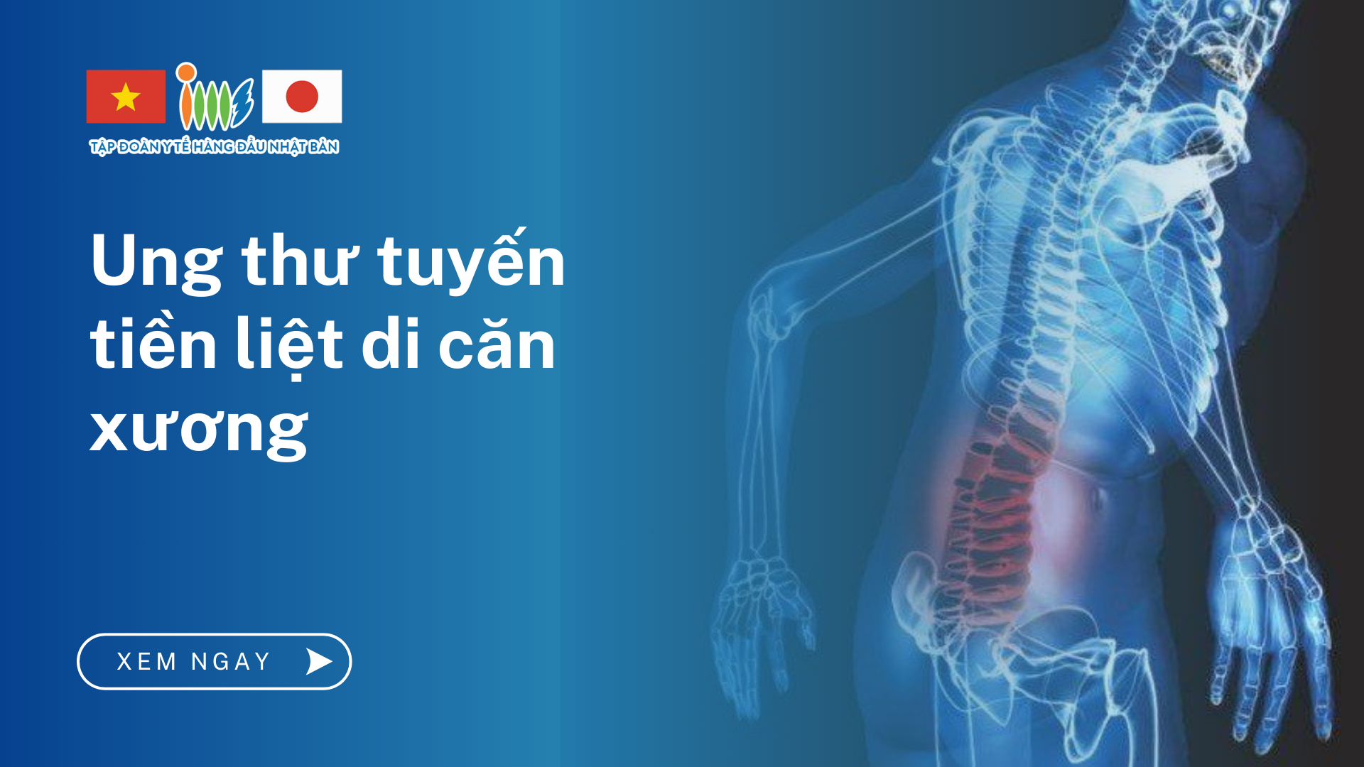 6 Điều Cần Biết Về Ung Thư Tuyến Tiền Liệt Di Căn Xương